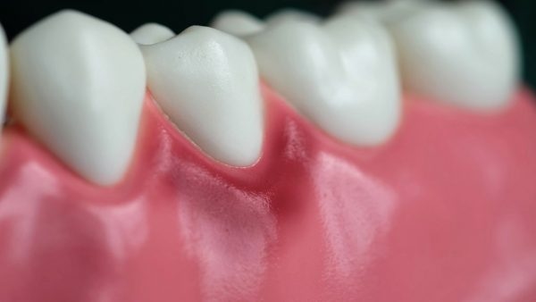 Viêm lợi là tình trạng viêm nhiễm tại nướu do vi khuẩn gây ra