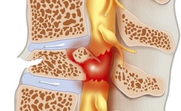 tủy sống bị tổn thương