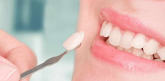 Chi phí dán răng sứ tại nha khoa bao nhiêu tiền?