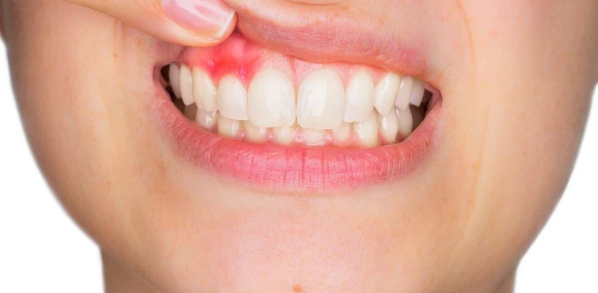 Chi phí điều trị áp xe răng có cao không?