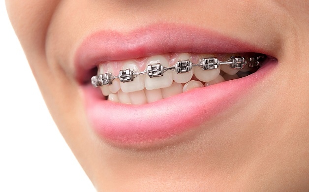 Mắc cài kịm loại là phương pháp có mức chi phí niềng răng thấp nhất hiện nay