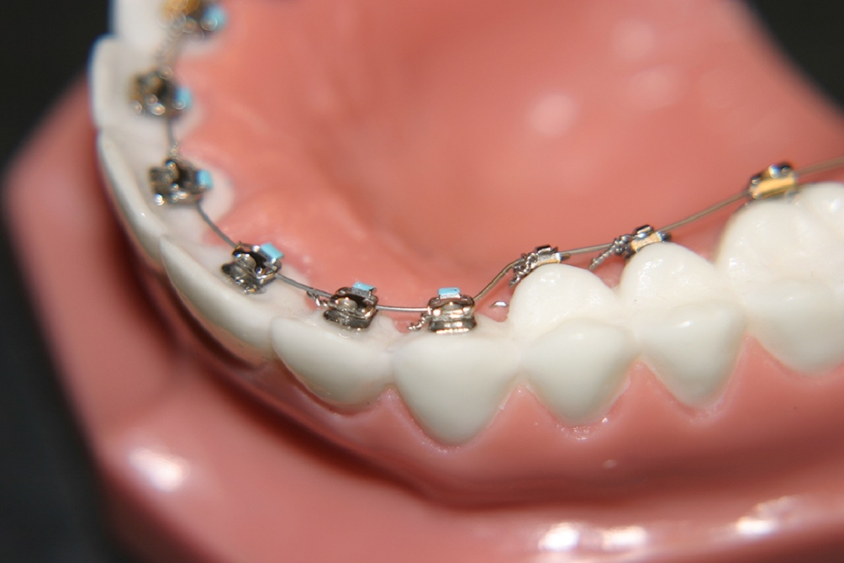 Chi phí niềng răng mặt trong hiện nay thế nào? 