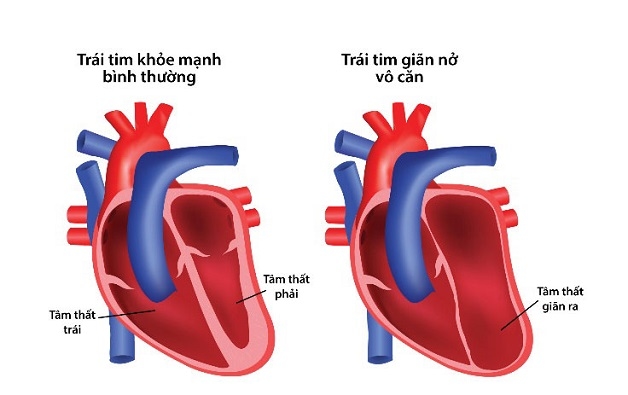 bệnh cơ tim giãn là gì