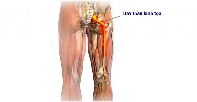 Đau thần kinh toa và cách chữa trị hiệu quả