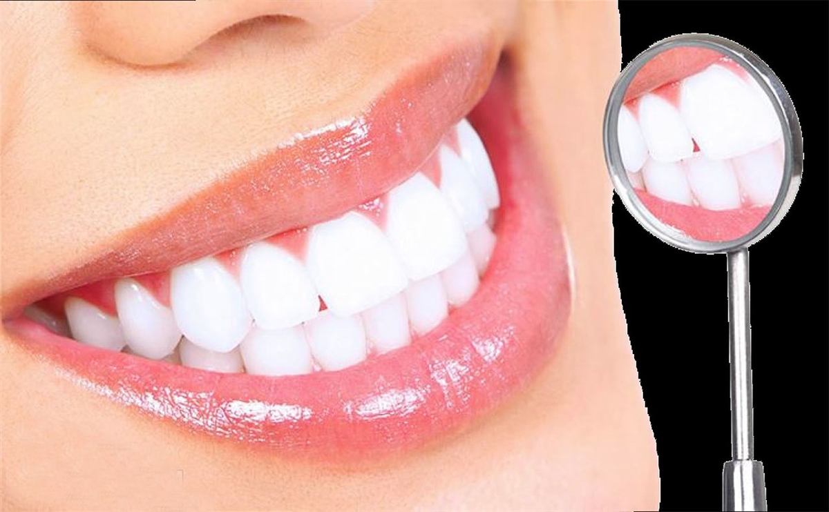 Giá dịch vụ tẩy trắng răng hiện nay là bao nhiêu? 