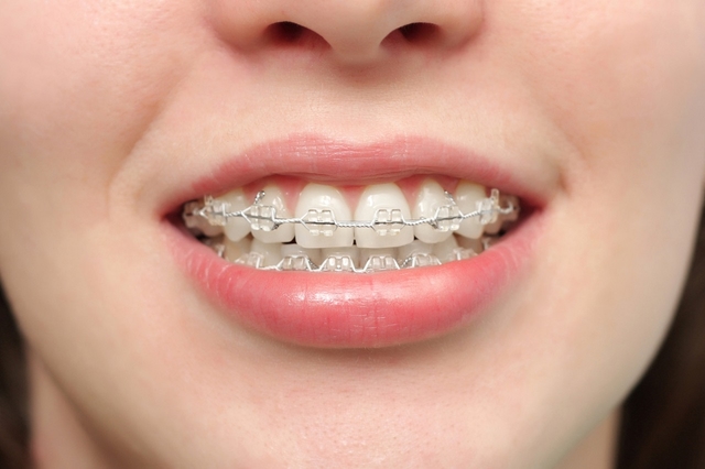 Niềng răng hô hiệu quả không, giá niềng răng hô bao nhiêu?