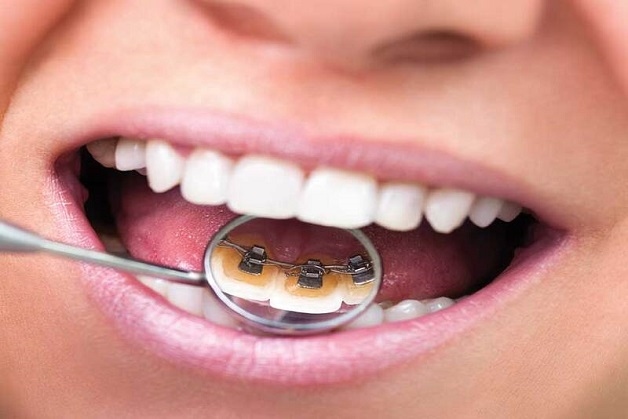 Niềng răng mặt trong là phương pháp này sử dụng hệ thống khí cụ được gắn vào mặt bên trong của thân răng