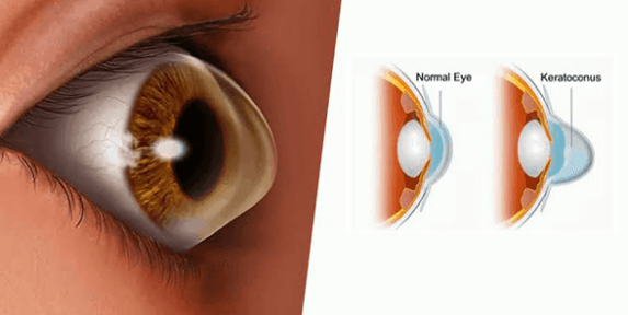 giác mạc của người mắc tật khúc xạ