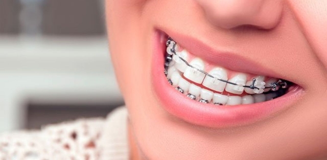 Giải đáp: Niềng 4 răng cửa giá bao nhiêu tiền hiện nay?