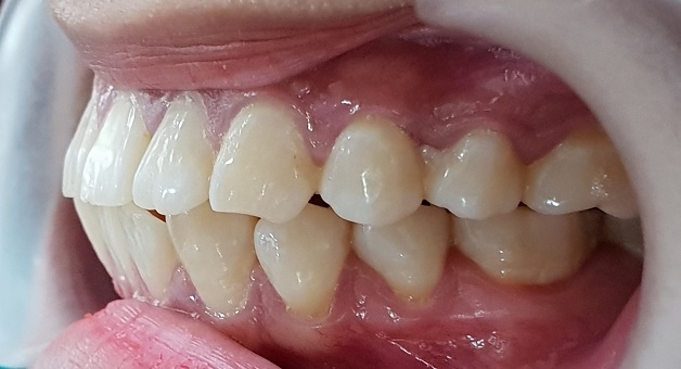 Răng hô không chỉ gây ảnh hưởng đến thẩm mỹ mà còn tiềm ẩn nhiều nguy cơ đe dọa sức khỏe răng miệng