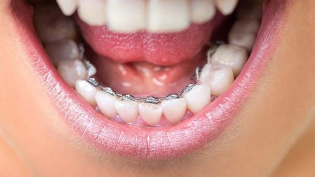GIẢI ĐÁP: Niềng răng khểnh bao nhiêu tiền? 
