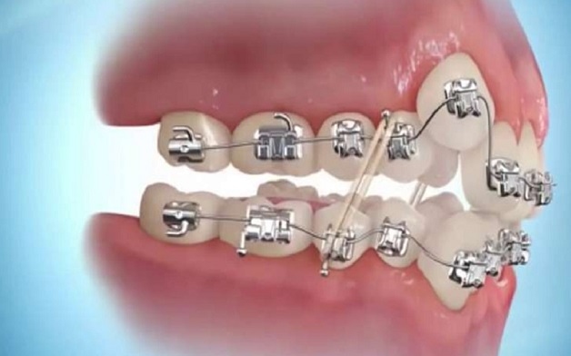 Với thắc mắc niềng răng khểnh bao nhiêu tiền, mỗi phương pháp niềng sẽ có mức giá khác nhau