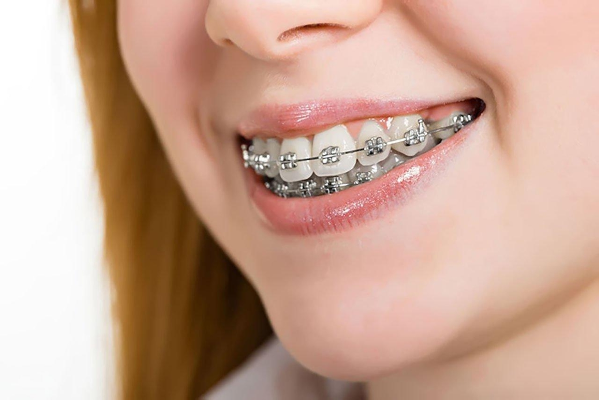 GIẢI ĐÁP: Niềng răng khoảng bao nhiêu tiền? 