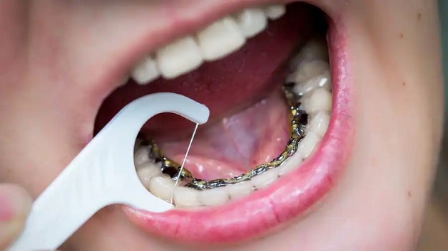 Niềng răng mặt trong giá bao nhiêu còn phụ thuộc vào nhiều yếu tố như: Địa chỉ thực hiện, tay nghề bác sĩ... 