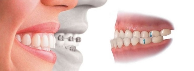 Niềng răng móm bao nhiêu tiền còn phụ thuộc vào từng phương pháp niềng răng