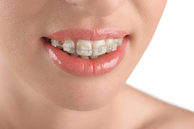 GIẢI ĐÁP: Niềng răng sứ bao nhiêu tiền? 