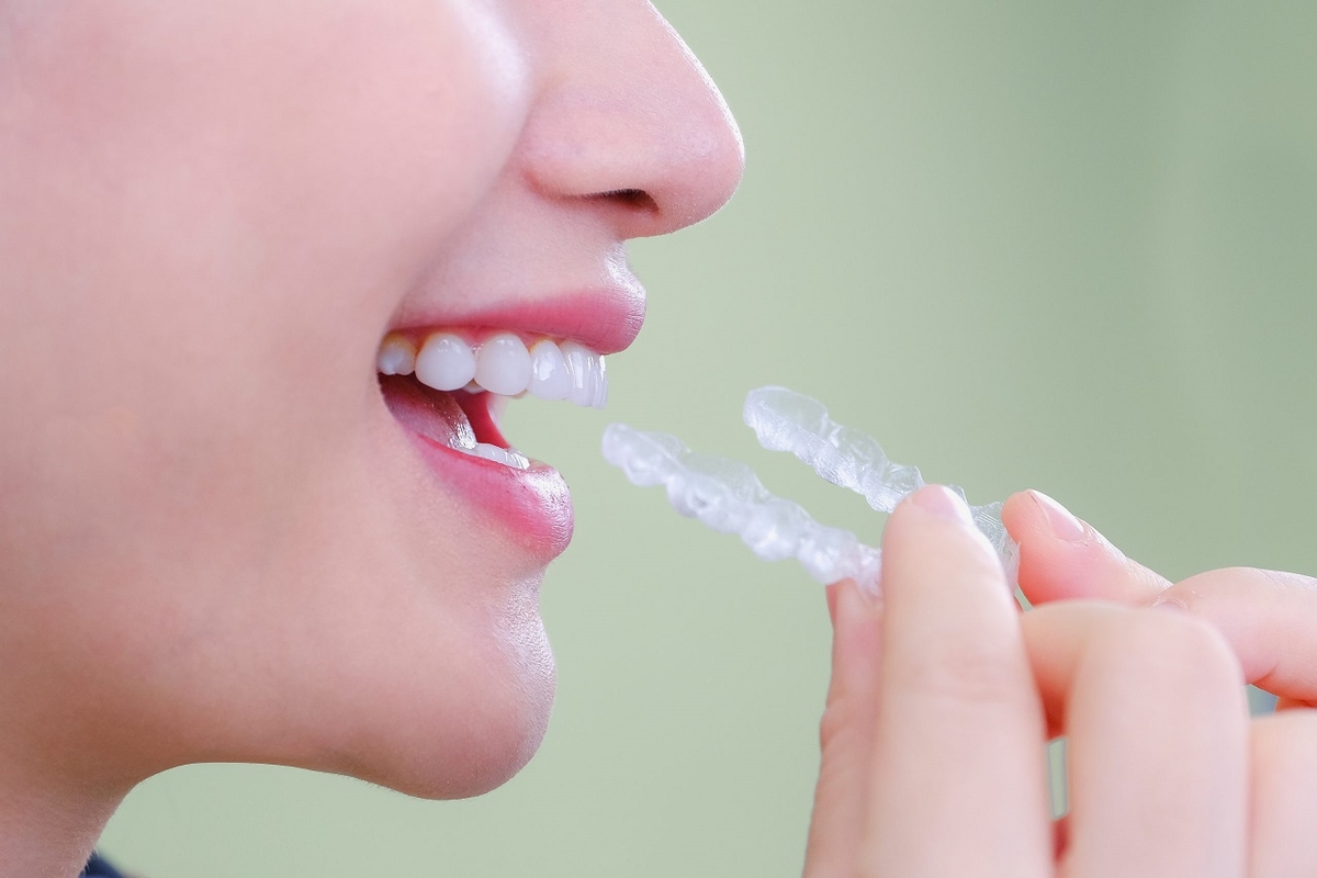Niềng răng trong suốt giá bao nhiêu?