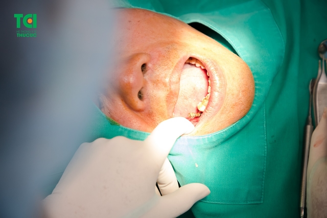 Giá nhổ răng sâu có cao không, nên chọn nha khoa nào để nhổ răng sâu?