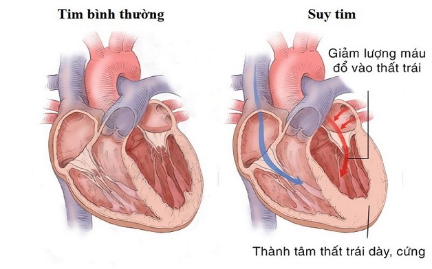 Suy tim cấp là gì?