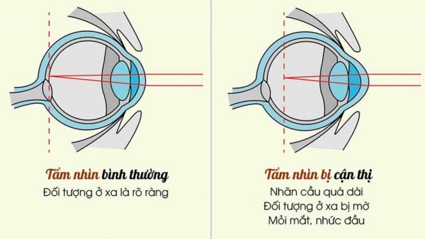 thoái hóa võng mạc cận thị
