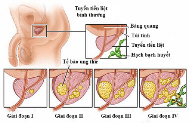 Ung thư tuyến tiền liệt chữa được hay không tùy thuộc vào giai đoạn phát hiện bệnh
