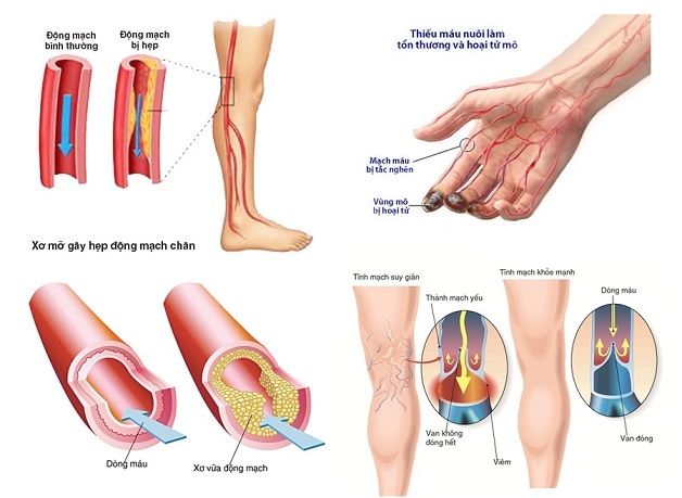 Bệnh mạch máu ngoại vi là gì