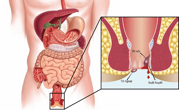 Bệnh trĩ khám ở đâu nên biết