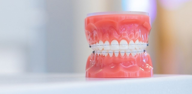Tìm hiểu về các loại niềng răng và chi phí niềng hiện nay
