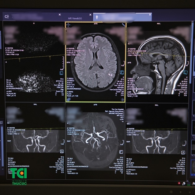 chụp MRI não là gì? hình ảnh của bệnh nhân