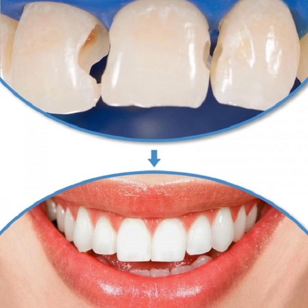 Hình ảnh trước và sau hàn răng là lời giải đáp thuyết phục cho câu hỏi 