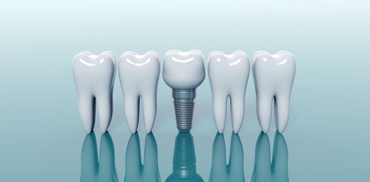 Tìm hiểu về giá trồng răng chi tiết nhất hiện nay