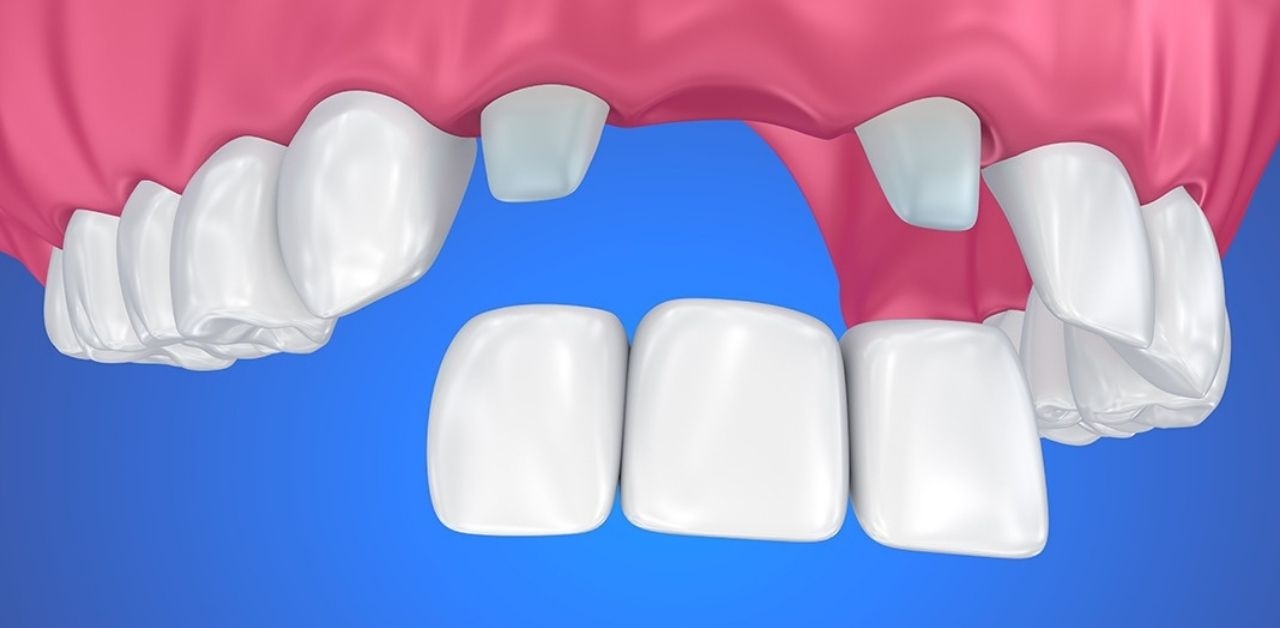Giá trồng răng cửa hiện nay tại nha khoa