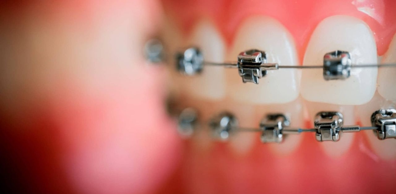 TCI giải đáp: Niềng 2 răng cửa bị hô bao nhiêu tiền