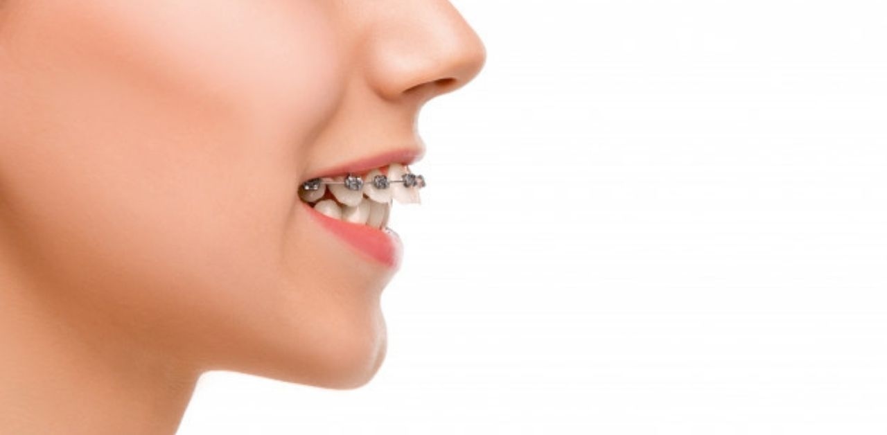 Niềng răng 1 hàm giá bao nhiêu, có nên niềng không?