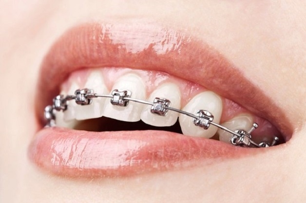 Niềng răng hàm trên áp là phương án tiết kiệm chi phí, thời gian hiệu quả so với niềng răng cả 2 hàm