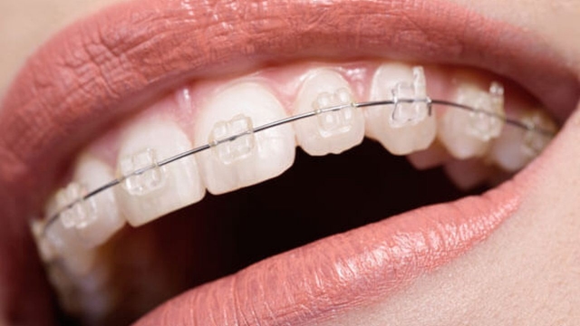 GIẢI ĐÁP: Niềng răng hàm trên bao nhiêu tiền