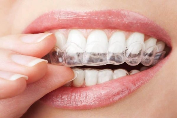 Phương pháp niềng răng bằng khay niềng trong suốt giúp điều chỉnh răng thưa về vị trí mong muốn trên cung hàm