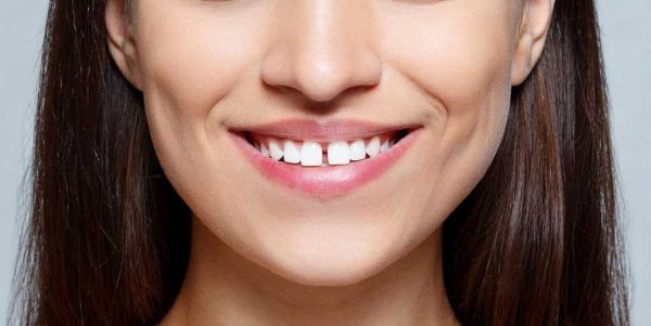 Trường hợp răng thưa hở kẽ lớn gây mất thẩm mỹ và ảnh hưởng tới khả năng nhai sẽ được bác sĩ chỉ định niềng