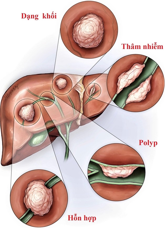 các phương pháp phẫu thuật ung thư đường mật