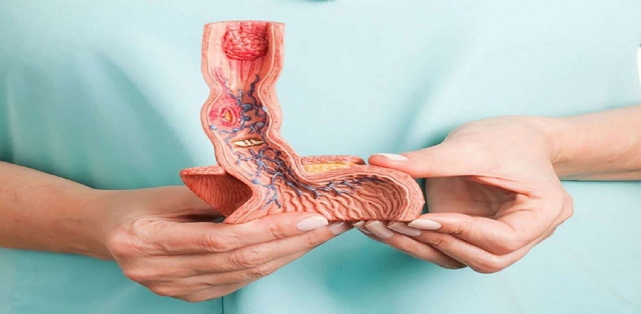 Cách chữa ung thư thực quản &#8211; Những điều bạn cần biết