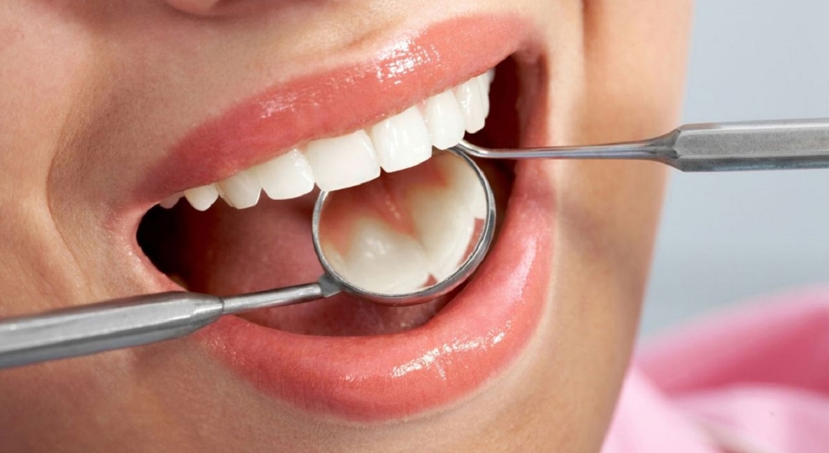 Trồng răng bao nhiêu tiền, phương pháp nào tốt?