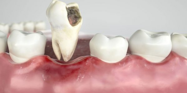 Bệnh lý hoặc chấn thương có thể khiến răng hàm bị mất hoặc phải nhổ bỏ