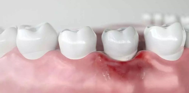 Viêm chân răng: Nguyên nhân gây bệnh và cách điều trị dứt điểm