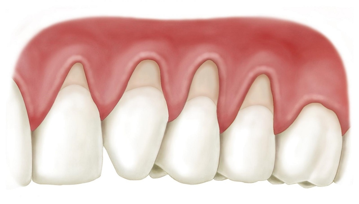 Bệnh viêm lợi: Dấu hiệu và cách điều trị 