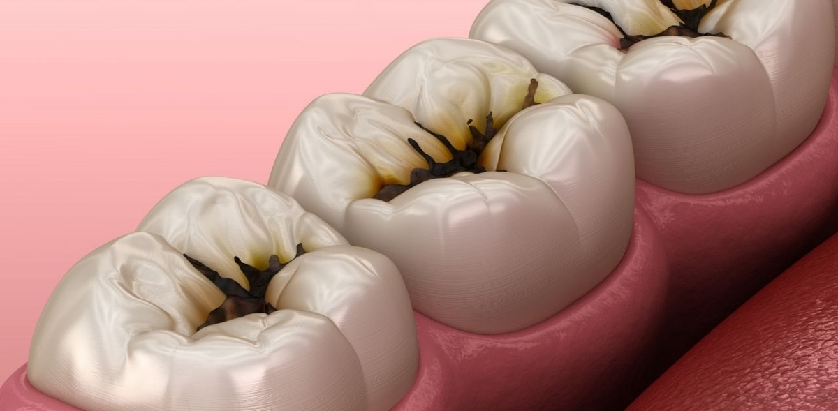 Giải đáp: Bị sâu răng có tẩy trắng được không?