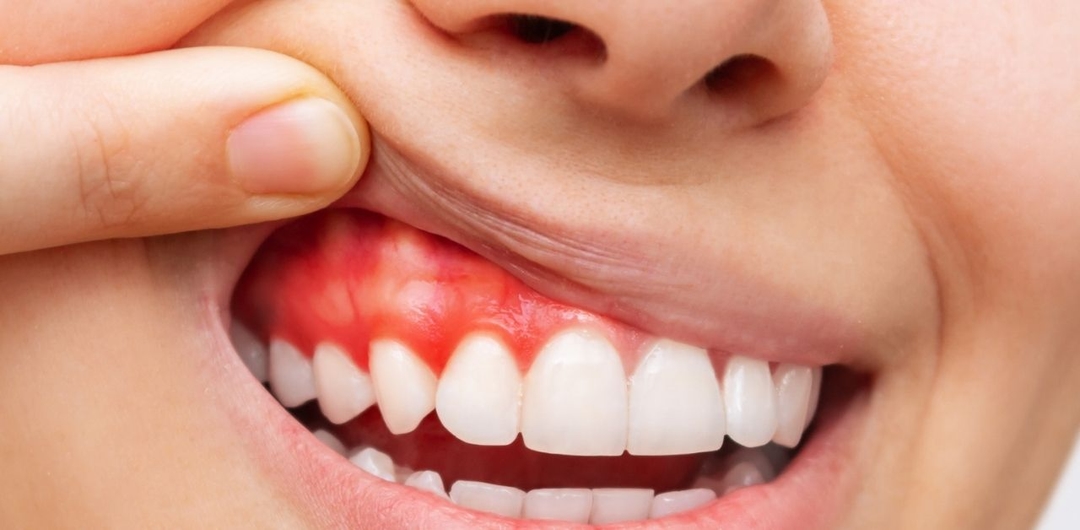 Biểu hiện viêm quanh cuống răng cần biết