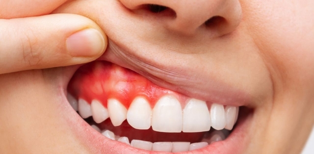 Biểu hiện viêm quanh cuống răng cần biết