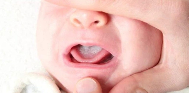 Cách chữa nấm miệng cho trẻ phòng ngừa tái phát