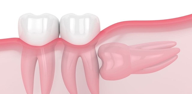 Có bao nhiêu răng số 8 trên cung hàm người trưởng thành?