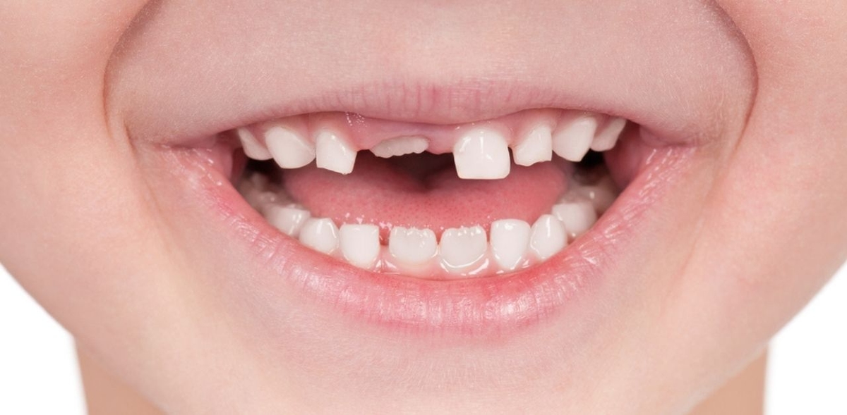 Có bao nhiêu răng sữa phải thay ở trẻ nhỏ?